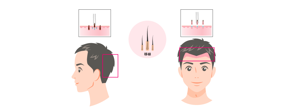 AGAが進行していない、後頭部・側頭部から元気な毛を採取します。毛包ごと採取した毛をAGAが進行している箇所に移植します。