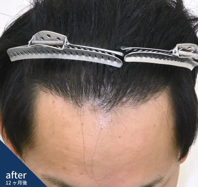 30代男性 AGA治療歴がある方の生え際改善 After