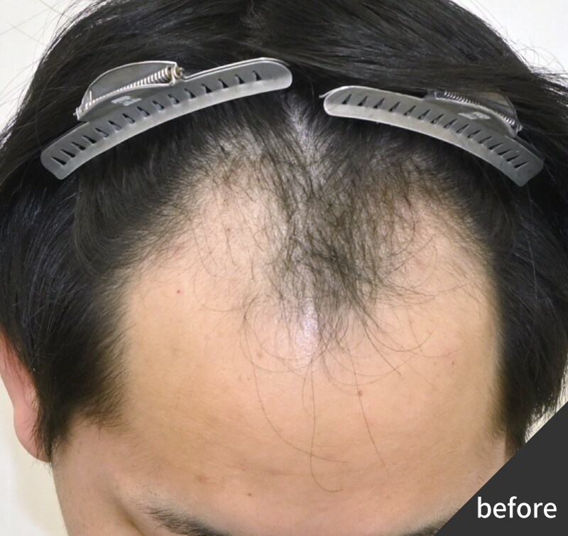 30代男性 AGA治療歴がある方の生え際改善 Before