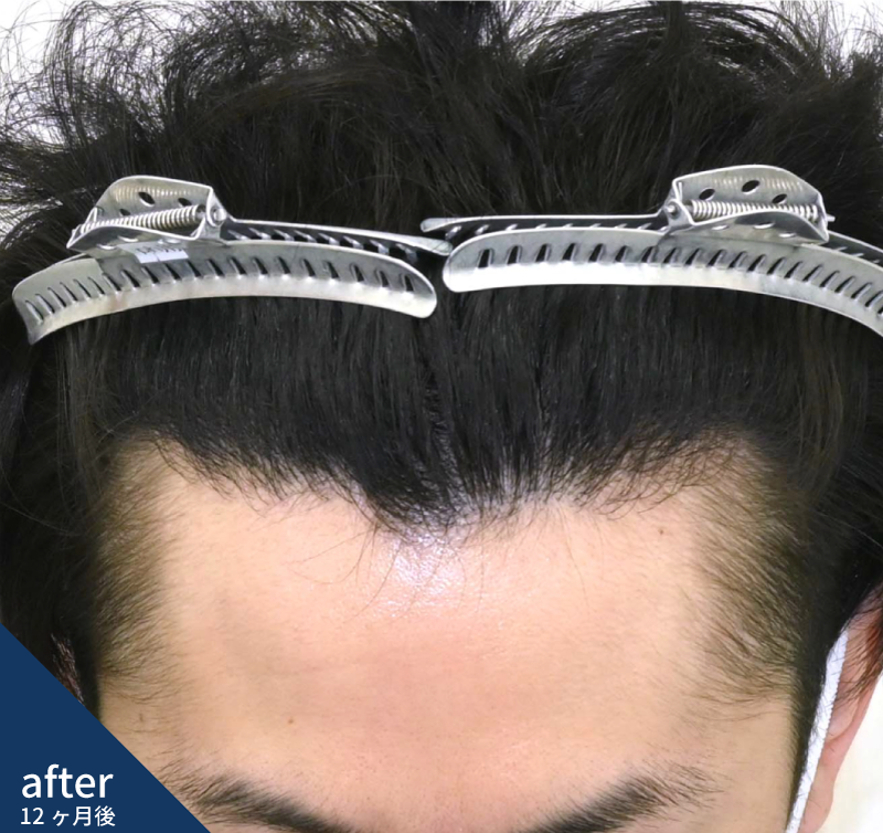 20代男性 おでこを狭くする+M字矯正 After