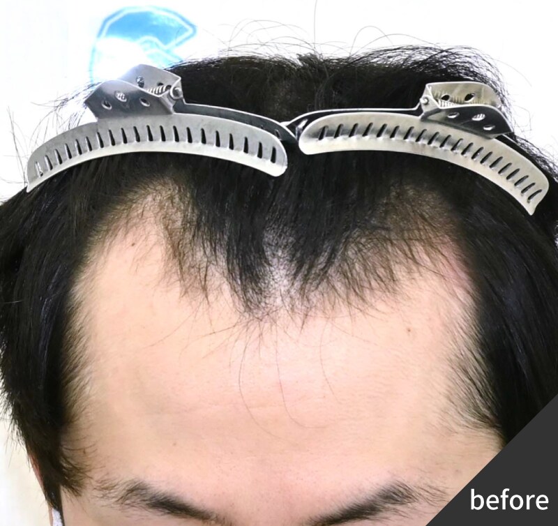 20代男性 おでこを狭くする+M字矯正 Before