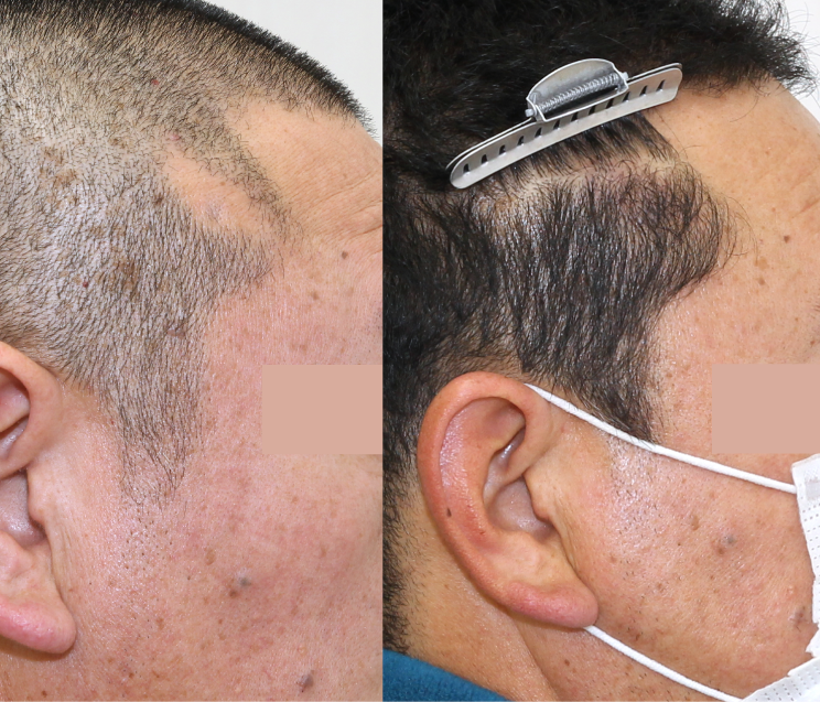 他院修正・傷跡植毛も対応