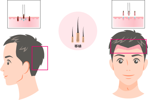 AGAが進行していない、後頭部・側頭部から元気な毛を採取します。毛包ごと採取した毛をAGAが進行している箇所に移植します。