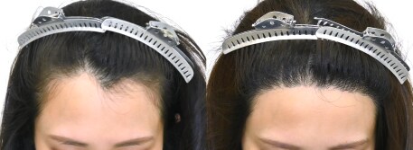 女性自毛植毛の症例写真ビフォーアフター