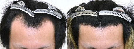 自毛植毛_1500G　症例写真ビフォーアフター