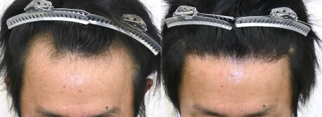 自毛植毛の症例写真ビフォーアフター