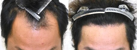 自毛植毛の症例写真ビフォーアフター