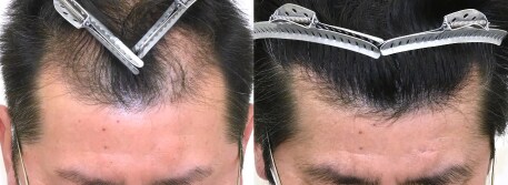 自毛植毛の症例写真ビフォーアフター