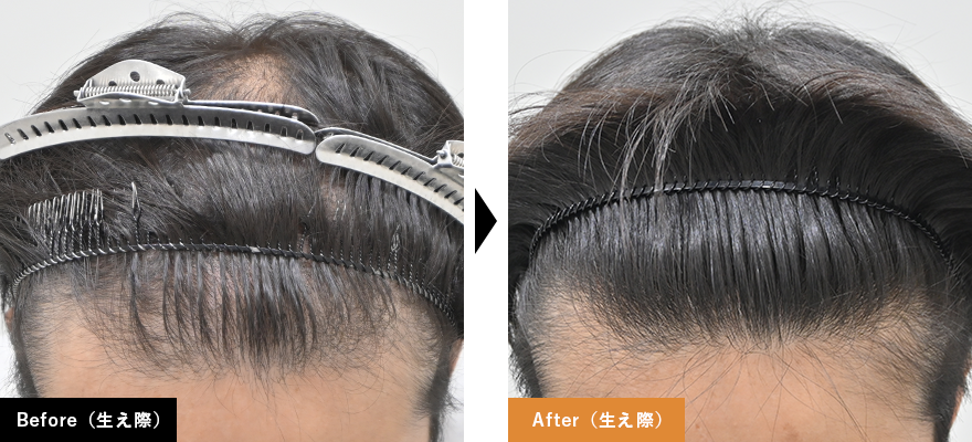 Before After (生え際)