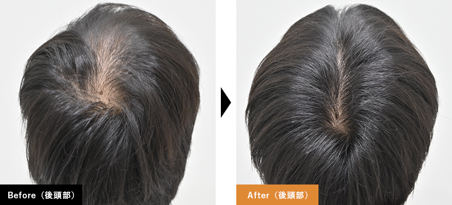Before After (生え際)