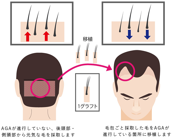 AGAが進行していない、後頭部・側頭部から元気な毛を採取します。毛包ごと採取した毛をAGAが進行している箇所に移植します。