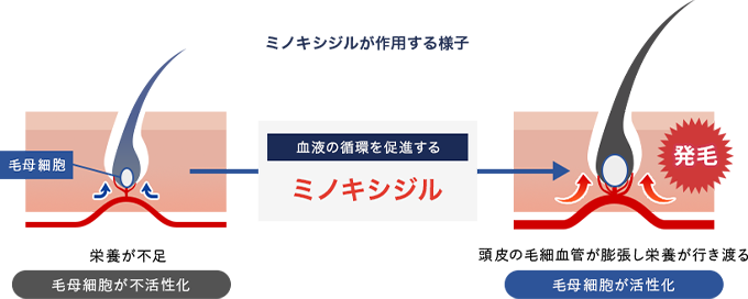 生える！効果実感3ヶ月コース｜湘南AGAクリニックの薄毛治療・自毛植毛