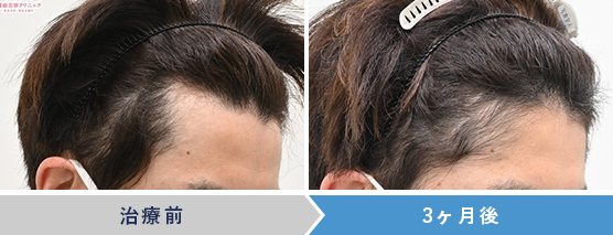 AGA治療薬の症例写真 治療前 治療3ヶ月後