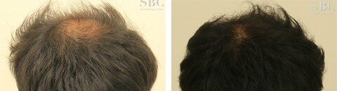 アルタス植毛で治療したAGA薄毛治療の症例写真（笠井敬一郎医師） Before After