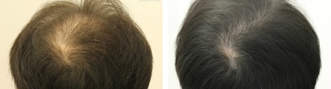 アルタス植毛で治療したAGA薄毛治療の症例写真（湘南美容クリニック 医師） Before After