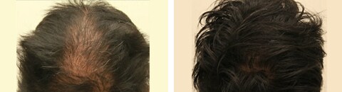 AGA治療薬で治療したAGA薄毛治療の症例写真（笠井敬一郎医師） Before After