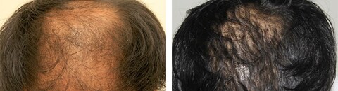 アルタス植毛で治療したAGA薄毛治療の症例写真（笠井敬一郎医師） Before After