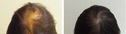 スマートメソプレミアムで治療したAGA薄毛治療の症例写真（斎藤浩一郎医師） Before After
