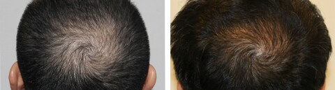 植毛で治療したAGA薄毛治療の症例写真（湘南美容クリニック医師） Before After