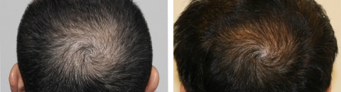 植毛で治療したAGA薄毛治療の症例写真（湘南美容クリニック医師） Before After