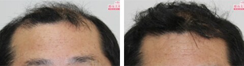 アルタス植毛で治療したAGA薄毛治療の症例写真（湘南美容クリニック医師） Before After
