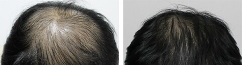 AGA治療薬で治療したAGA薄毛治療の症例写真（藤井傑医師） Before After