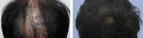 毛髪再生メソセラピーで治療したAGA薄毛治療の症例写真（藤井傑医師） Before After
