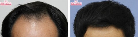 アルタス植毛で治療したAGA薄毛治療の症例写真（藤井傑医師） Before After