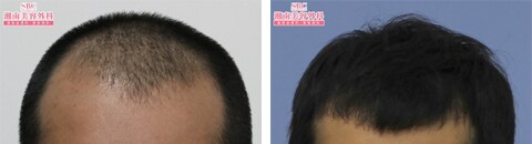 植毛で治療したAGA薄毛治療の症例写真（藤井傑医師） Before After