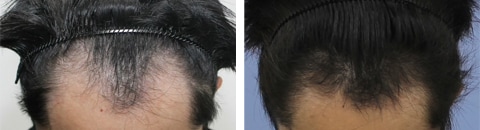 毛髪再生メソセラピーで治療したAGA薄毛治療の症例写真（藤井傑医師） Before After