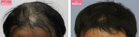 毛髪再生メソセラピーで治療したAGA薄毛治療の症例写真（藤井傑医師） Before After