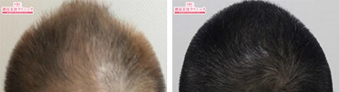 毛髪再生メソセラピーで治療したAGA薄毛治療の症例写真（藤井傑医師） Before After