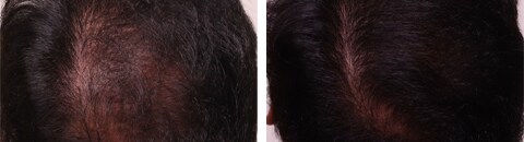 AGA治療薬で治療したAGA薄毛治療の症例写真（笠井敬一郎医師） Before After