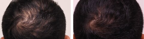 AGA治療薬で治療したAGA薄毛治療の症例写真（笠井敬一郎医師） Before After