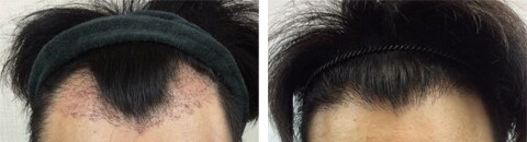 アルタス植毛で治療したAGA薄毛治療の症例写真（斎藤浩一医師） Before After