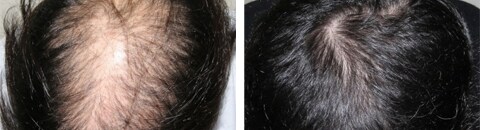 自毛植毛で治療したAGA薄毛治療の症例写真（笠井敬一郎医師） Before After