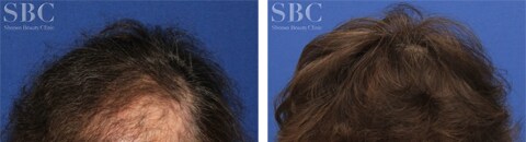 スマートメソプレミアムで治療したAGA薄毛治療の症例写真（笠井敬一郎郎医師） Before After