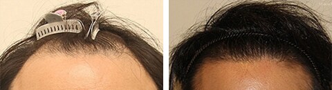 生えぎわで治療したAGA薄毛治療の症例写真（笠井敬一郎医師） Before After
