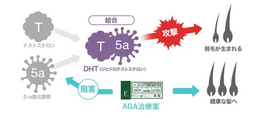 AGA進行の仕組みとAGA治療の効果 画像