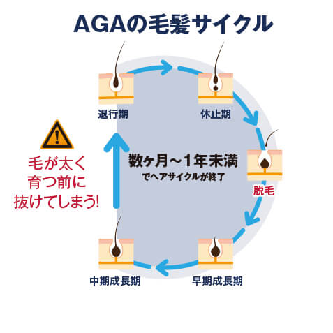 AGAの毛髪サイクル 画像