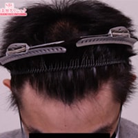 症例写真41