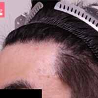 症例写真43