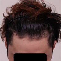 症例写真58