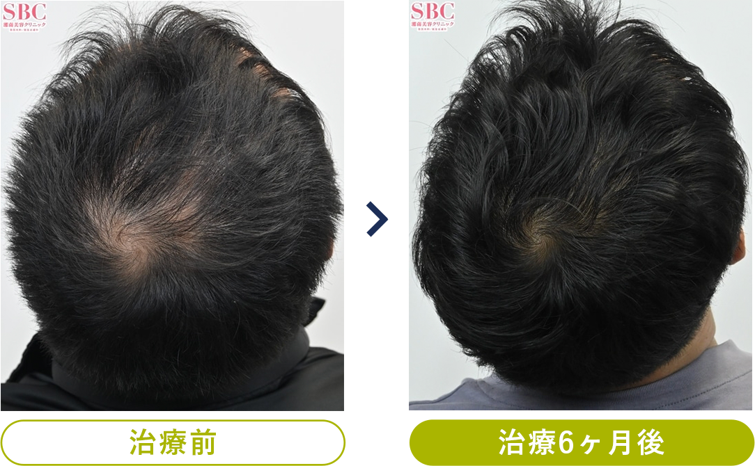 発毛プランの治療例 フィナステリド＋スプレー（フィナステリド0.5mg＋ミノキシジル6.5%） 6ヶ月の変化