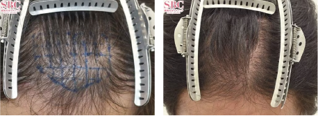 自毛植毛900Gの症例写真 治療前と治療6ヶ月後の比較