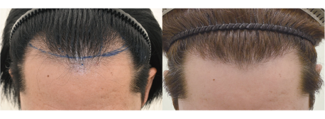 自毛植毛1000Gの症例写真 治療前と治療12ヶ月後の比較