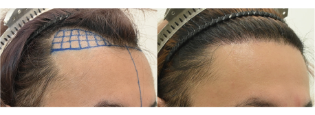 自毛植毛1000Gの症例写真 治療前と治療6ヶ月後の比較