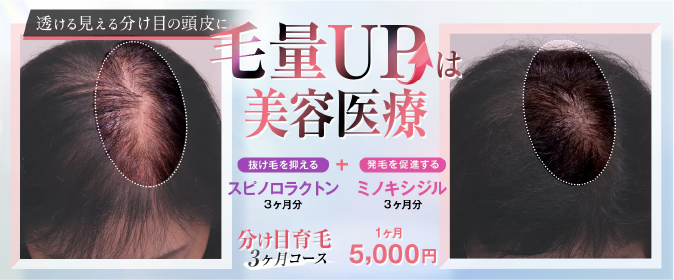 【女性】分け目育毛3ヶ月コース/15,000円