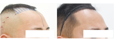 自毛植毛1600Gの症例写真 治療前と治療6ヶ月後の比較