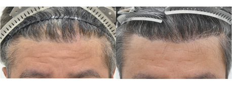 他医修正植毛800Gの症例写真 治療前と治療6ヶ月後の比較